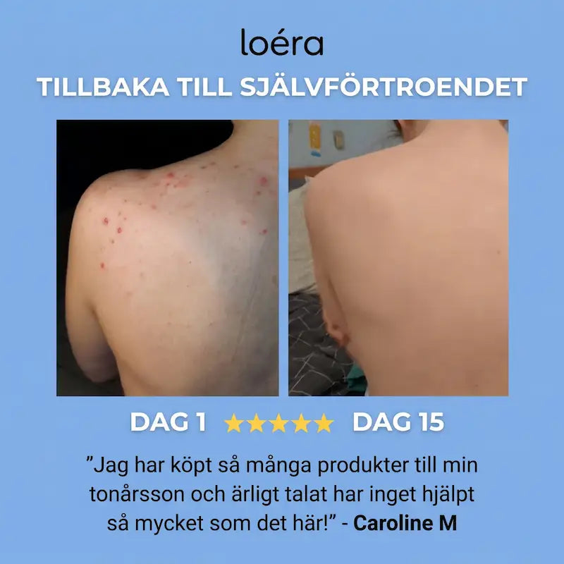 Loéra™ Kroppstvål mot akne